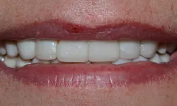 Thumbnail control image for Close-up of a person's lips and teeth showing white dental veneers or crowns with slight redness on the lips.