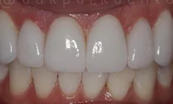 Thumbnail control image for Close-up of teeth showing bright white dental veneers on upper front teeth with natural lower teeth.