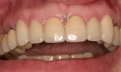 Thumbnail control image for Close-up of upper and lower teeth showing dental crowns and natural teeth with healthy gums.