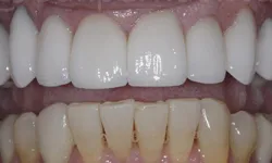Thumbnail control image for Comparison of upper teeth with bright white veneers and lower natural yellowed teeth showing dental transformation.