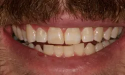 Thumbnail control image for Close-up of a smiling person's mouth showing natural, healthy teeth with slight gaps and facial hair.