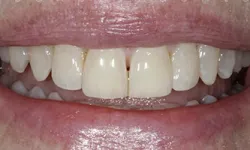 Thumbnail control image for Close-up of a person's mouth showing slightly yellowed teeth with small gaps and natural lips.