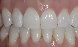 Thumbnail control image for Close-up of clean, well-aligned white teeth and healthy pink gums showing a natural smile.
