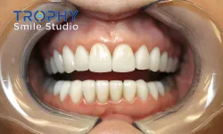Thumbnail control image for a person's mouth with teeth