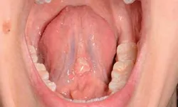 Thumbnail control image for Close-up of an open mouth showing teeth, tongue, and uvula inside the oral cavity.