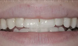 Thumbnail control image for Close-up of a slightly open mouth showing natural teeth with small gaps and minimal discoloration.
