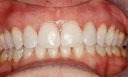 Thumbnail control image for Close-up of healthy white teeth and pink gums with slight yellowing near the molars and clean dental alignment.