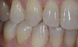 Thumbnail control image for Close-up of clean, healthy upper and lower teeth showing natural color and texture in the mouth.