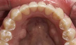 Thumbnail control image for Close-up image of upper dental arch showing natural teeth and gums from inside the mouth.
