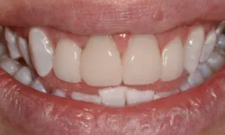 Thumbnail control image for Close-up of a smile showing misaligned upper and lower teeth with visible gaps and uneven edges.