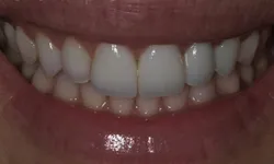 Thumbnail control image for Close-up of a healthy smile showing white, well-aligned teeth and natural gums.