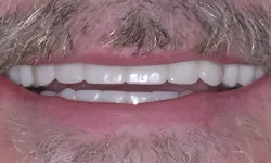 Thumbnail control image for Close-up of a smiling mouth with clean white teeth and facial hair around the lips and chin.