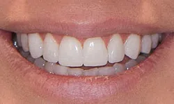 Thumbnail control image for Close-up of a smiling mouth showing clean, healthy white teeth and natural lips.