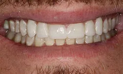 Thumbnail control image for Close-up of a smiling mouth showing upper and lower teeth with a slight gap and facial hair around the lips.