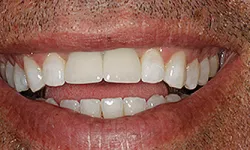 Thumbnail control image for Close-up of an adult male smiling showing teeth with natural texture and facial hair details.