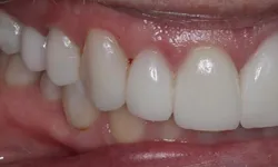 Thumbnail control image for Close-up of healthy white teeth and pink gums showing dental alignment and oral hygiene.