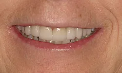 Thumbnail control image for Close-up of a smiling mouth showing clean, white teeth with natural skin texture around lips.