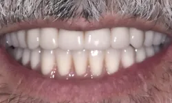 Thumbnail control image for Close-up of a smiling mouth with clean white teeth and a gray mustache above the lips.