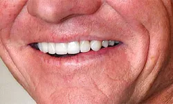 Thumbnail control image for Close-up of a smiling mouth showing white teeth and natural skin wrinkles around lips and cheeks.