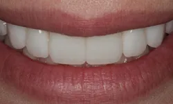 Thumbnail control image for Close-up of a bright, clean smile with evenly aligned white teeth and natural pink lips