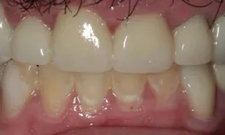 Thumbnail control image for Close-up of lower front teeth showing gum recession and plaque buildup on teeth surfaces.