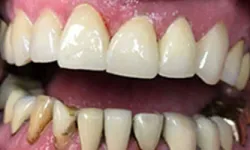 Thumbnail control image for Close-up image of upper and lower teeth showing dental plaque and discoloration on lower teeth.