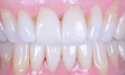 Thumbnail control image for Close-up of clean, healthy teeth with natural gums and bright white enamel, showing full smile alignment.