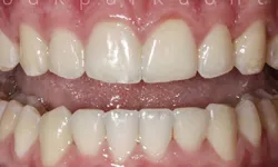 Thumbnail control image for Close-up of upper and lower human teeth showing natural alignment and gum texture in healthy mouth.