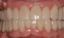 Thumbnail control image for Close-up of healthy white human teeth with pink gums in a natural smile showing upper and lower arches.