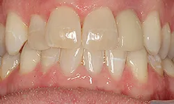 Thumbnail control image for Close-up view of human teeth showing mild crowding and gum health in natural lighting.