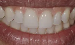 Thumbnail control image for Close-up of a person's smile showing clean, white teeth and healthy lips with natural texture.