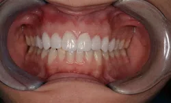 Thumbnail control image for Close-up view of a person's open mouth showing clean, aligned teeth and healthy gums with a dental cheek retractor.