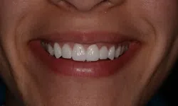 Thumbnail control image for Close-up of a person smiling showing clean, white, and evenly aligned teeth with natural skin texture visible.