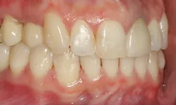 Thumbnail control image for Close-up of upper and lower teeth showing slight misalignment and dental plaque on gums and teeth.