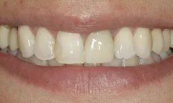 Thumbnail control image for Close-up of a smile showing teeth with slight discoloration and natural lips, focused on dental appearance.