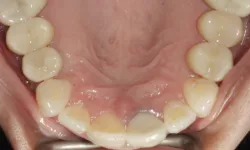 Thumbnail control image for Close-up of lower teeth showing dental discoloration and plaque buildup on inner front teeth.