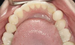 Thumbnail control image for Close-up of upper dental arch with teeth and visible tongue inside mouth, showing oral anatomy and dental health.