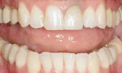 Thumbnail control image for Close-up of healthy human teeth showing upper and lower dental arches with natural color and alignment.