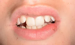 Thumbnail control image for Close-up of a mouth with teeth showing and a cold sore on the lower lip of a person with fair skin.