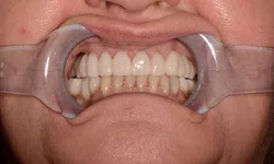 Thumbnail control image for Close-up of a person's mouth with dental retractors showing clean white upper teeth and natural lower teeth.