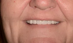 Thumbnail control image for Close-up of a person's mouth smiling, showcasing clean and well-aligned white teeth and natural skin texture.