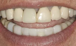 Thumbnail control image for Close-up of a smiling mouth showing upper and lower teeth with some discoloration and dental work.