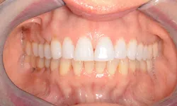 Thumbnail control image for Close-up of a person's mouth showing upper and lower teeth with dental cheek retractors in place.