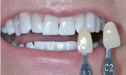 Thumbnail control image for Close-up of teeth with shade guide tabs A3 and C2 used for dental color matching.