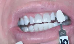 Thumbnail control image for Close-up of teeth with dental shade guide for color matching in dental treatment.