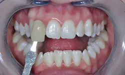 Thumbnail control image for Close-up of a dental shade guide matching tooth color against natural teeth with mouth retractor in place
