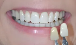 Thumbnail control image for Close-up of a smiling mouth with white teeth and dental shade guide comparing tooth color.
