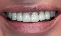 Thumbnail control image for Close-up of a smiling mouth showing bright, even, and healthy white teeth and pink lips.