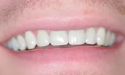 Thumbnail control image for Close-up of a smiling mouth showing clean, white teeth and natural lips with light facial hair.