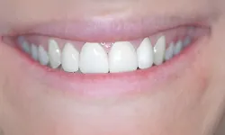 Thumbnail control image for Close-up of a smiling mouth with white, healthy teeth and pink lips.